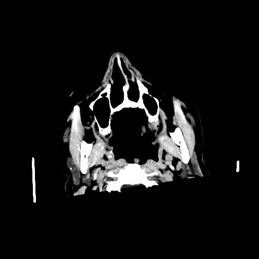 Chronic bilateral subdural hygroma (Radiopaedia 85801-101622 Axial non-contrast 12).jpg