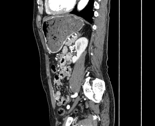 File:Chronic contained rupture of abdominal aortic aneurysm with extensive erosion of the vertebral bodies (Radiopaedia 55450-61901 B 53).jpg