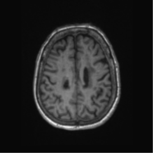 File:Chronic hypertensive encephalopathy (Radiopaedia 72844-83495 Axial T1 22).png