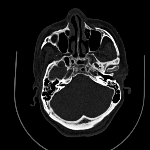 Chronic invasive fungal sinusitis (Radiopaedia 91563-109286 Axial sinus 40).jpg