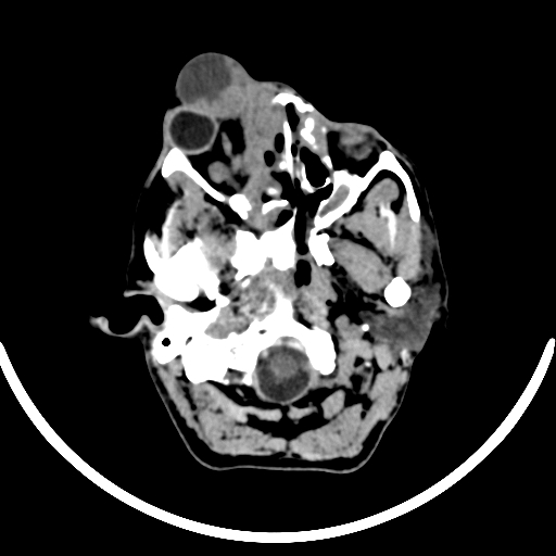 File:Chronic invasive fungal sinusitis with intraorbital and intracranial extension (Radiopaedia 56387-63046 Axial non-contrast 93).jpg