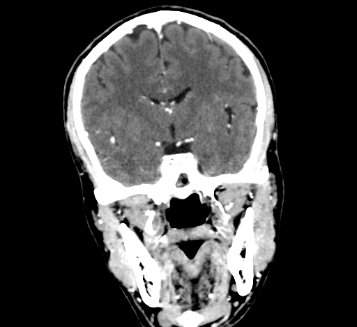 Chronic invasive fungal sinusitis with intraorbital and intracranial extension (Radiopaedia 56387-63046 C 190).jpg