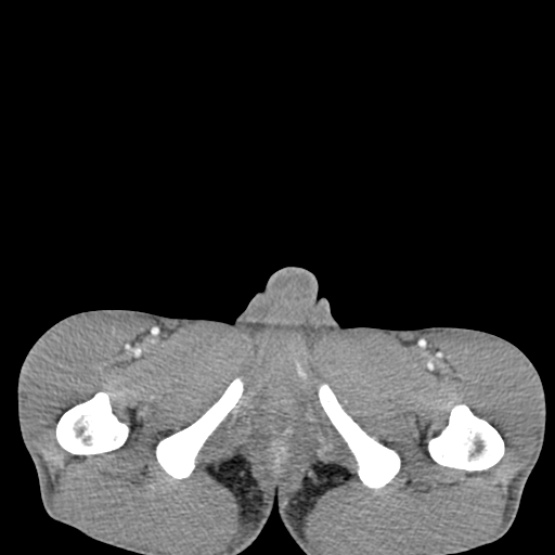 Chronic large bowel pseudo-obstruction (Radiopaedia 43181-46492 A 171).jpg