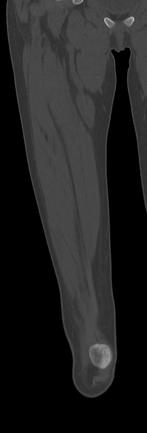 Chronic ostemyelitis of the femur with long sinus tract (Radiopaedia 74947-85982 Coronal bone window 26).jpg