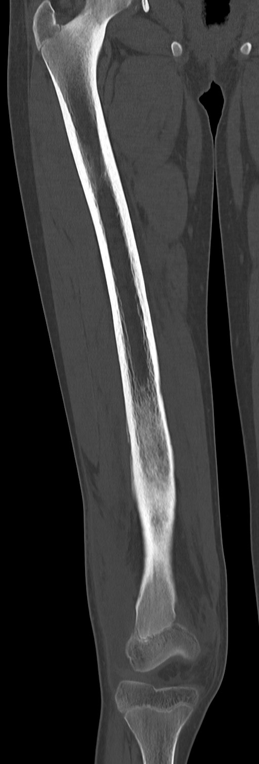 Chronic ostemyelitis of the femur with long sinus tract (Radiopaedia 74947-85982 Coronal bone window 39).jpg