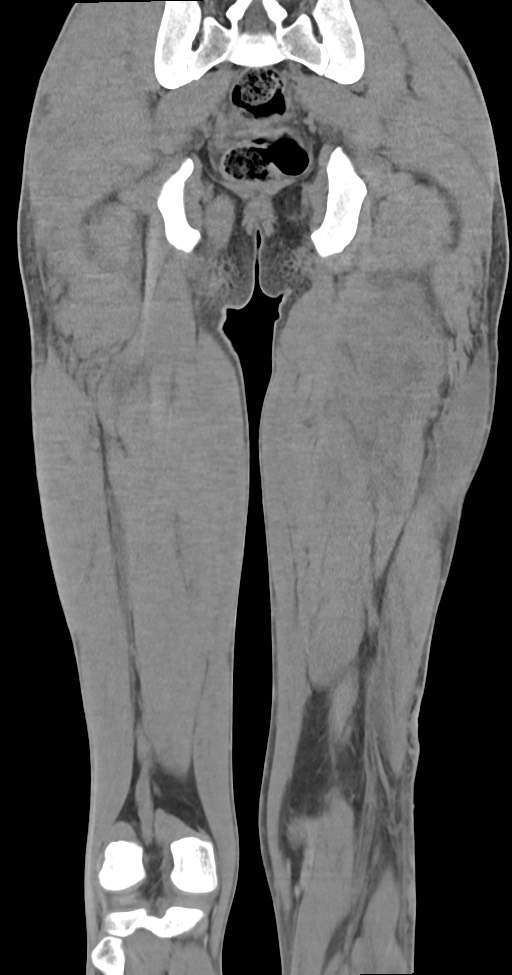 Chronic osteomyelitis (with sequestrum) (Radiopaedia 74813-85822 E 41).jpg