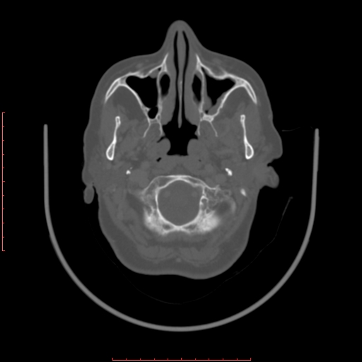 Chronic osteomyelitis - maxilla (Radiopaedia 23783-23927 Axial bone window 107).jpg