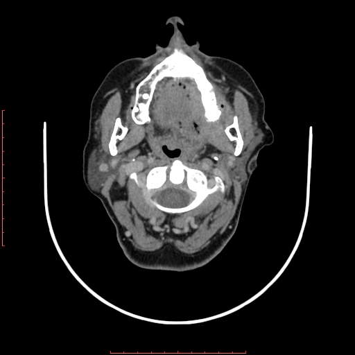 File:Chronic osteomyelitis - maxilla (Radiopaedia 23783-23927 B 62).jpg