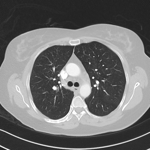 Chronic pulmonary embolus (Radiopaedia 39129-41341 Axial lung window 24).png