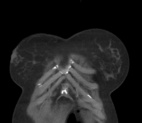 Chronic pulmonary embolus (Radiopaedia 39129-41341 Coronal C+ CTPA 11).png