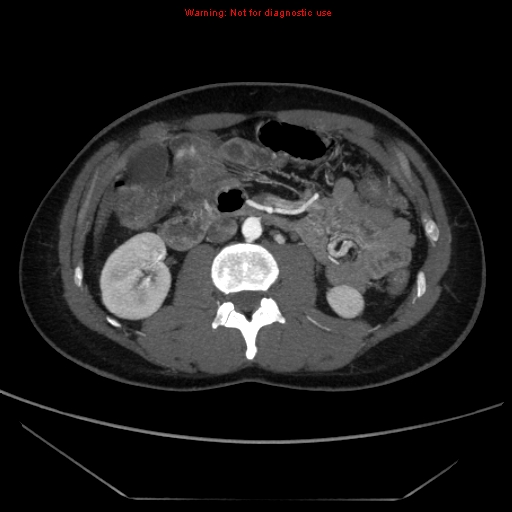File:Circumaortic left renal vein (Radiopaedia 9069-9792 A 29).jpg