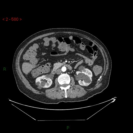 File:Circumaortic left renal vein and doubled left renal arteries (Radiopaedia 52268-58158 A 116).jpg