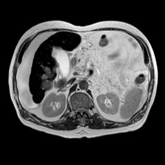 File:Cirrhosis and hepatocellular carcinoma in the setting of hemochromatosis (Radiopaedia 75394-86594 Axial T2 12).jpg