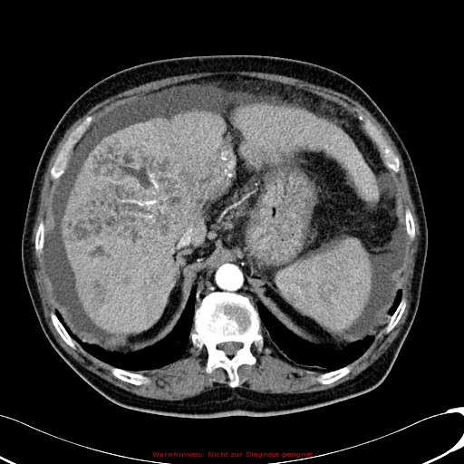 File:Cirrhosis and hepatocellular carcinoma in the setting of hemochromatosis (Radiopaedia 75394-86595 A 26).jpg