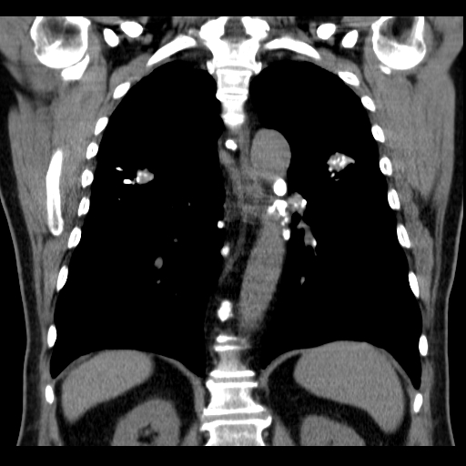 Classic complicated silicosis (Radiopaedia 49720-54961 Coronal liver window 40).jpg