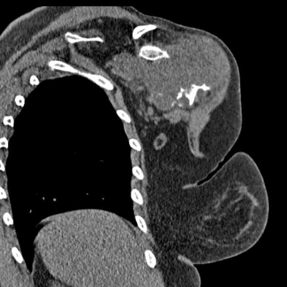 Clear cell chondrosarcoma - humerus (Radiopaedia 63104-71612 Coronal non-contrast 41).jpg