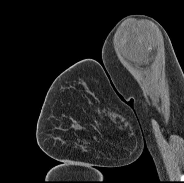 Clear cell chondrosarcoma - humerus (Radiopaedia 63104-71612 D 10).jpg
