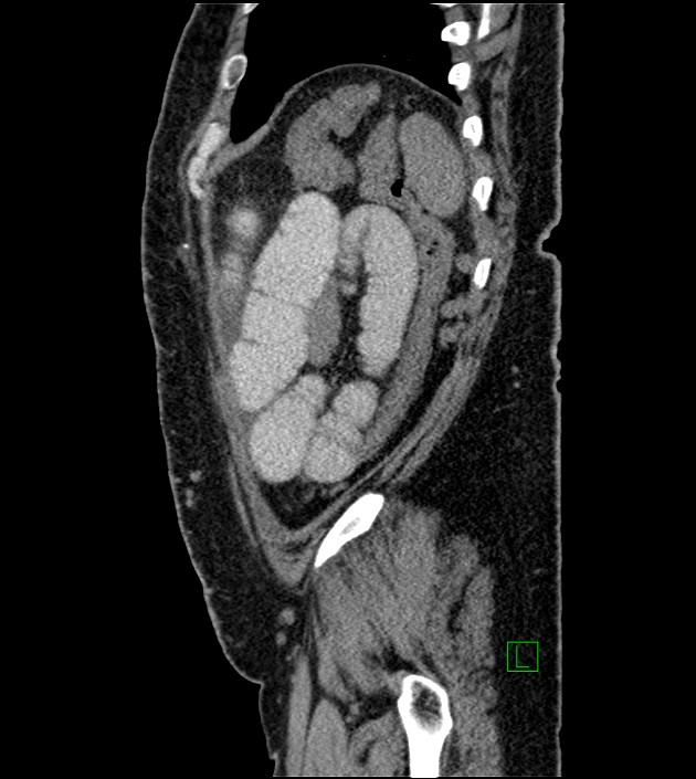 Closed-loop small bowel obstruction-internal hernia (Radiopaedia 78439-91096 C 30).jpg
