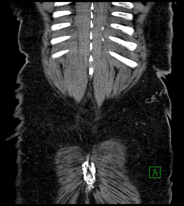 Closed-loop small bowel obstruction-internal hernia (Radiopaedia 78439-91096 Coronal non-contrast 92).jpg