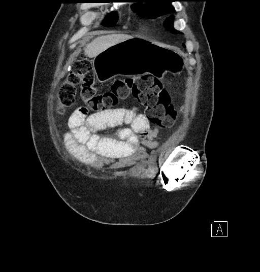 File:Closed loop obstruction - internal hernia into nephrectomy bed (Radiopaedia 59867-67320 B 13).jpg