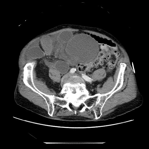 File:Closed loop small bowel obstruction - adhesive disease and hemorrhagic ischemia (Radiopaedia 86831-102990 A 132).jpg