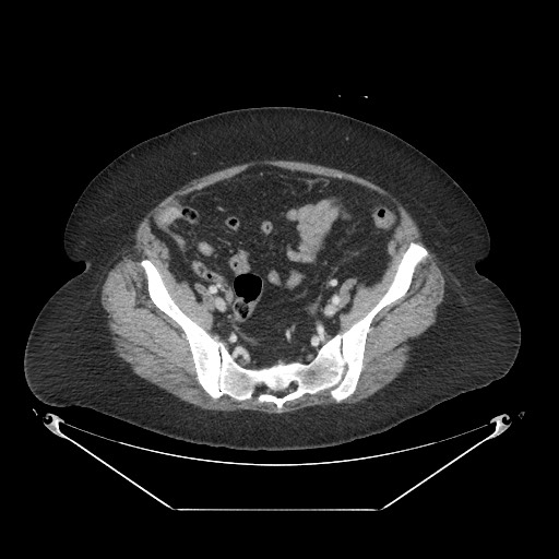 Closed loop small bowel obstruction - internal hernia (Radiopaedia 65402-74450 A 102).jpg