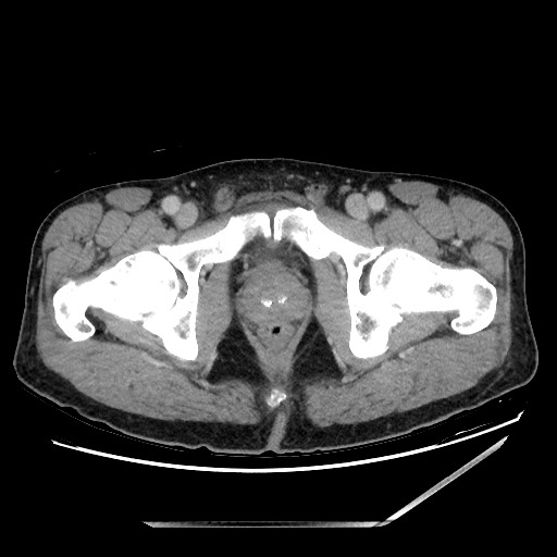 Closed loop small bowel obstruction - omental adhesion causing "internal hernia" (Radiopaedia 85129-100682 A 168).jpg
