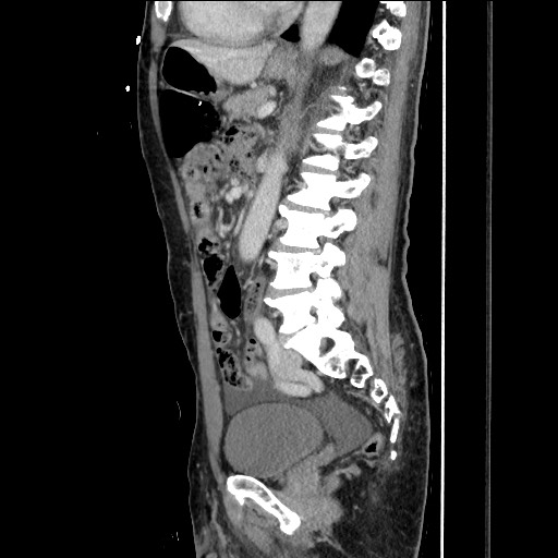 Closed loop small bowel obstruction - omental adhesion causing "internal hernia" (Radiopaedia 85129-100682 C 105).jpg