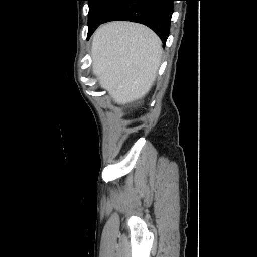 Closed loop small bowel obstruction - omental adhesion causing "internal hernia" (Radiopaedia 85129-100682 C 36).jpg