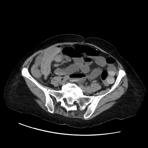 File:Closed loop small bowel obstruction due to adhesive band, with intramural hemorrhage and ischemia (Radiopaedia 83831-99017 Axial non-contrast 109).jpg