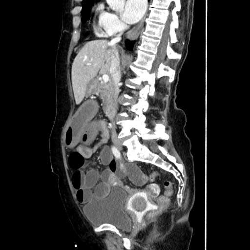 Closed loop small bowel obstruction due to adhesive band, with intramural hemorrhage and ischemia (Radiopaedia 83831-99017 D 97).jpg