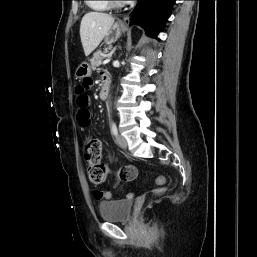 Closed loop small bowel obstruction due to adhesive bands - early and late images (Radiopaedia 83830-99014 C 103).jpg