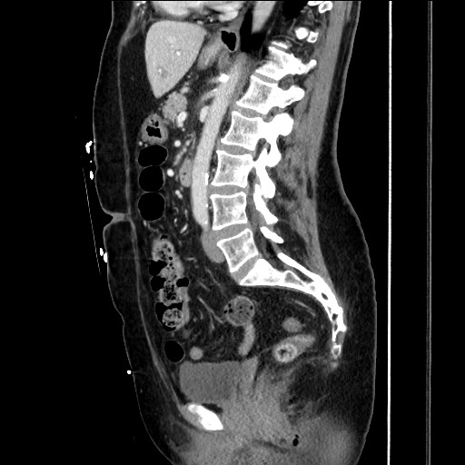 File:Closed loop small bowel obstruction due to adhesive bands - early and late images (Radiopaedia 83830-99014 C 99).jpg