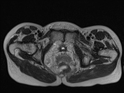 Closed loop small bowel obstruction in pregnancy (MRI) (Radiopaedia 87637-104031 D 40).jpg