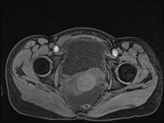 Closed loop small bowel obstruction in pregnancy (MRI) (Radiopaedia 87637-104031 F 64).jpg