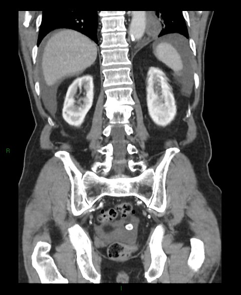 Closed loop small bowel obstruction with ischemia (Radiopaedia 84180-99456 B 17).jpg