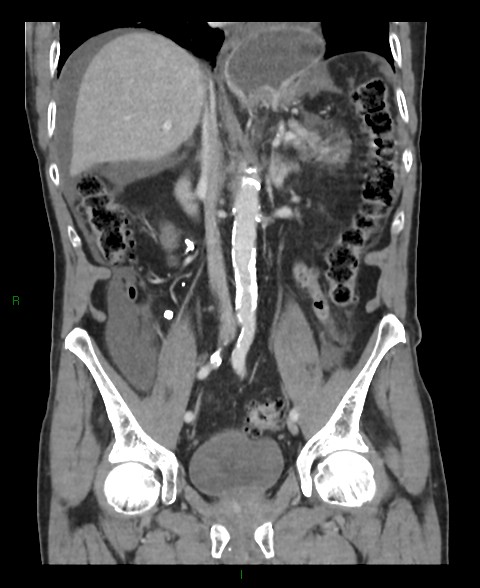 Closed loop small bowel obstruction with ischemia (Radiopaedia 84180-99456 B 32).jpg