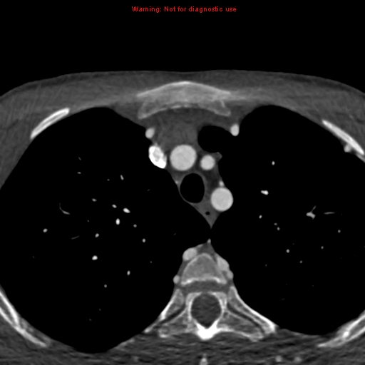 File:Coarctation of the aorta (Radiopaedia 12461-12697 A 7).jpg