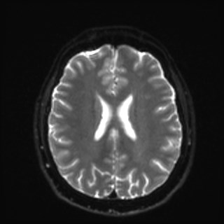 File:Cochlear incomplete partition type III associated with hypothalamic hamartoma (Radiopaedia 88756-105498 Axial DWI 26).jpg