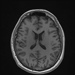 File:Cochlear incomplete partition type III associated with hypothalamic hamartoma (Radiopaedia 88756-105498 Axial T1 120).jpg