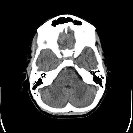 Colloid cyst (Radiopaedia 78104-90633 Axial non-contrast 27).jpg