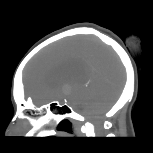 File:Colloid cyst (resulting in death) (Radiopaedia 33423-34499 B 29).png