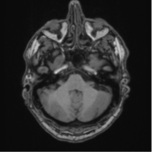 File:Colloid cyst of the third ventricle (Radiopaedia 86571-102662 Axial T1 20).png