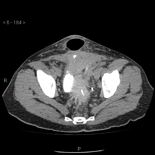 File:Colo-cutaneous fistula (Radiopaedia 40531-43129 A 77).jpg