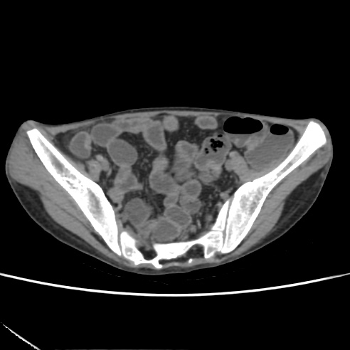 File:Colocolic fistula - Crohn disease (Radiopaedia 57063-63955 A 70).jpg