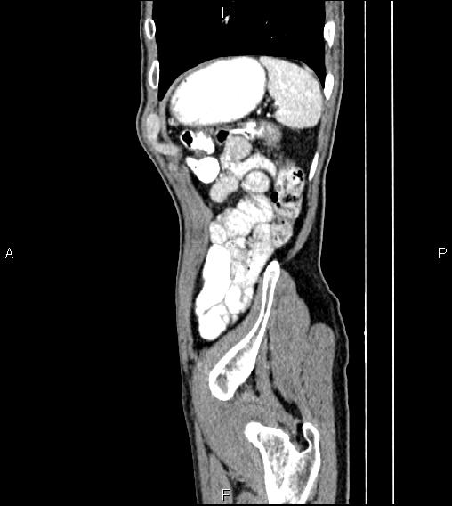 Colon adenocarcinoma - hepatic flexure (Radiopaedia 85635-101395 D 78).jpg