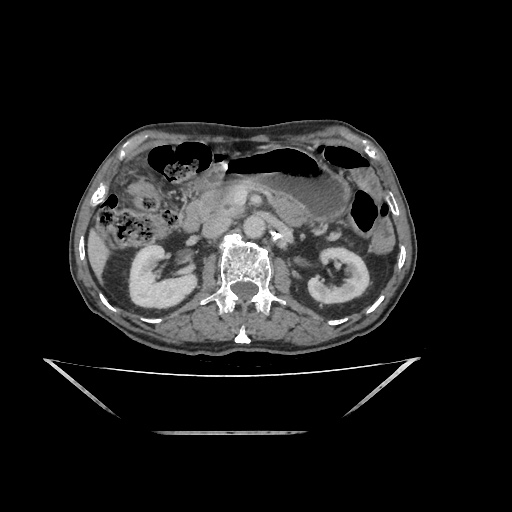 Colon cancer (ultrasound) (Radiopaedia 77249-89300 A 66).jpg
