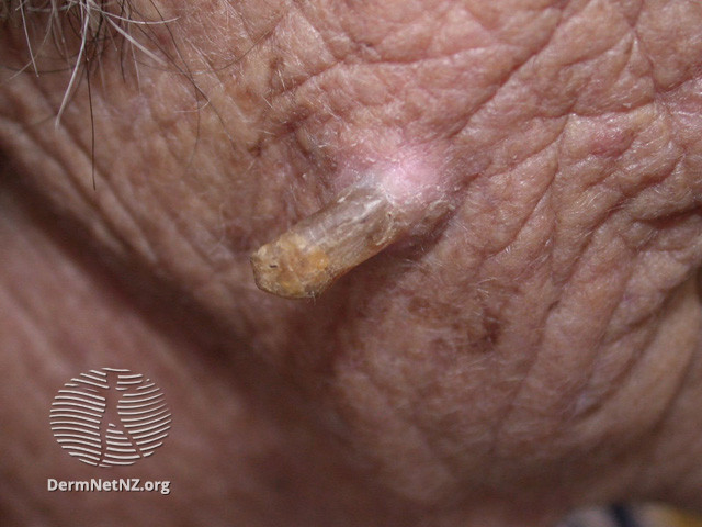 File:Cutaneous horn (DermNet NZ lesions-horn-01).jpg