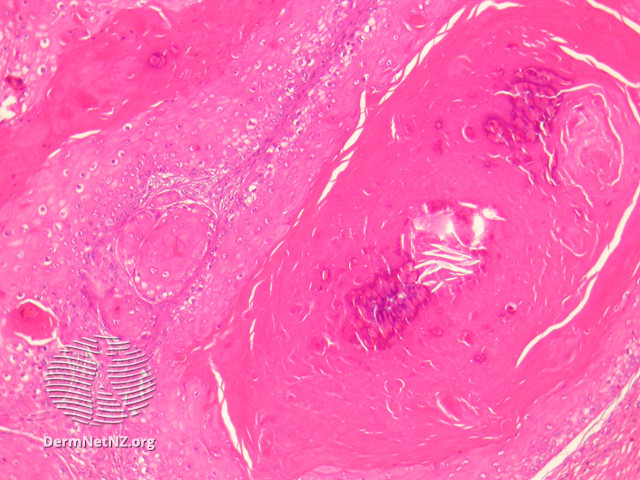 File:Figure 2 (DermNet NZ pathology-e-proliferating-trichilemmal-cyst-fig-2).jpg