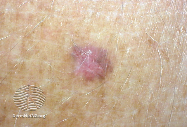 File:Macro image of amelanotic melanoma 4 (DermNet NZ amelanotic-melanoma4-macro).jpg
